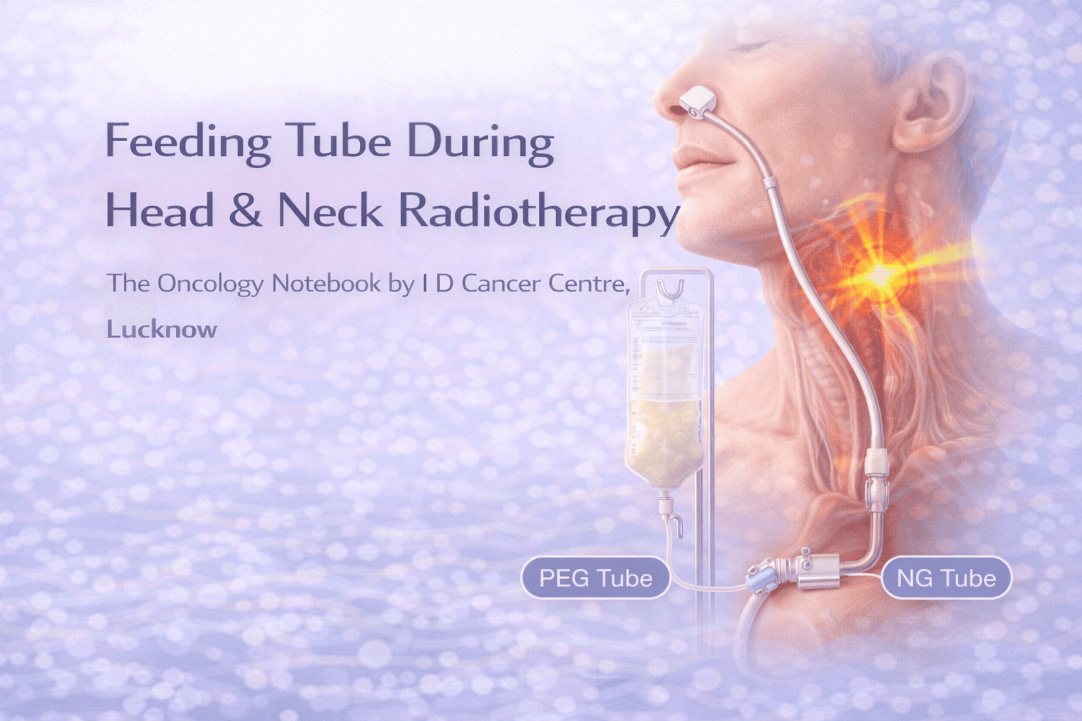 Feeding Tube During Head & Neck Radiotherapy | IDCC